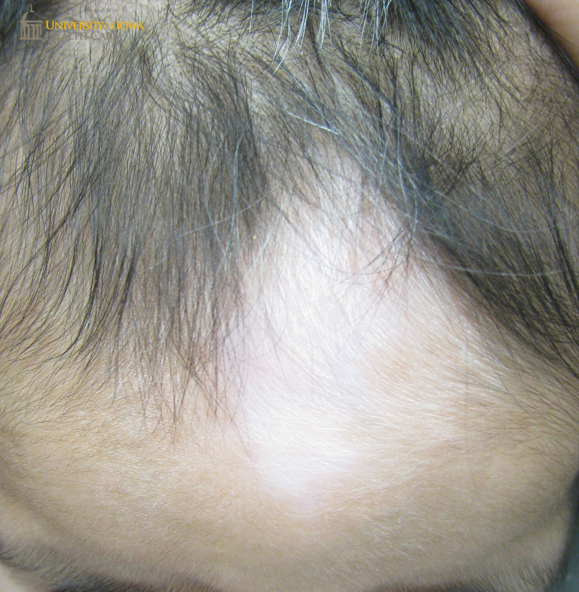 Digmented patch with white forelock on the frontal scalp. (click images for higher resolution).